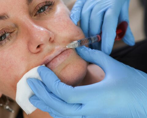 Can Lip Fillers Affect Your Smile? A Guide for UK Clients