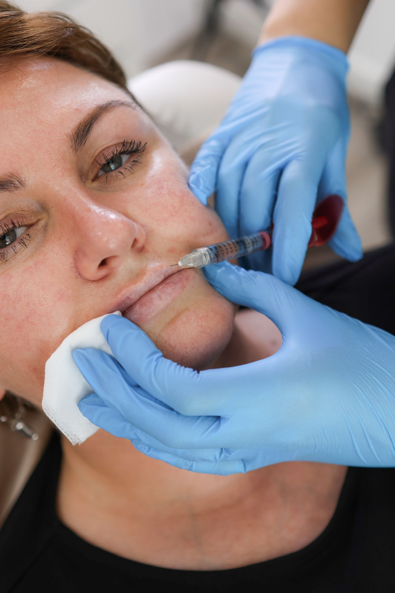 Can Lip Fillers Affect Your Smile? A Guide for UK Clients