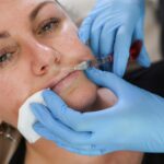 Lip Filler FAQs: Everything You Need to Know Before Getting Injections