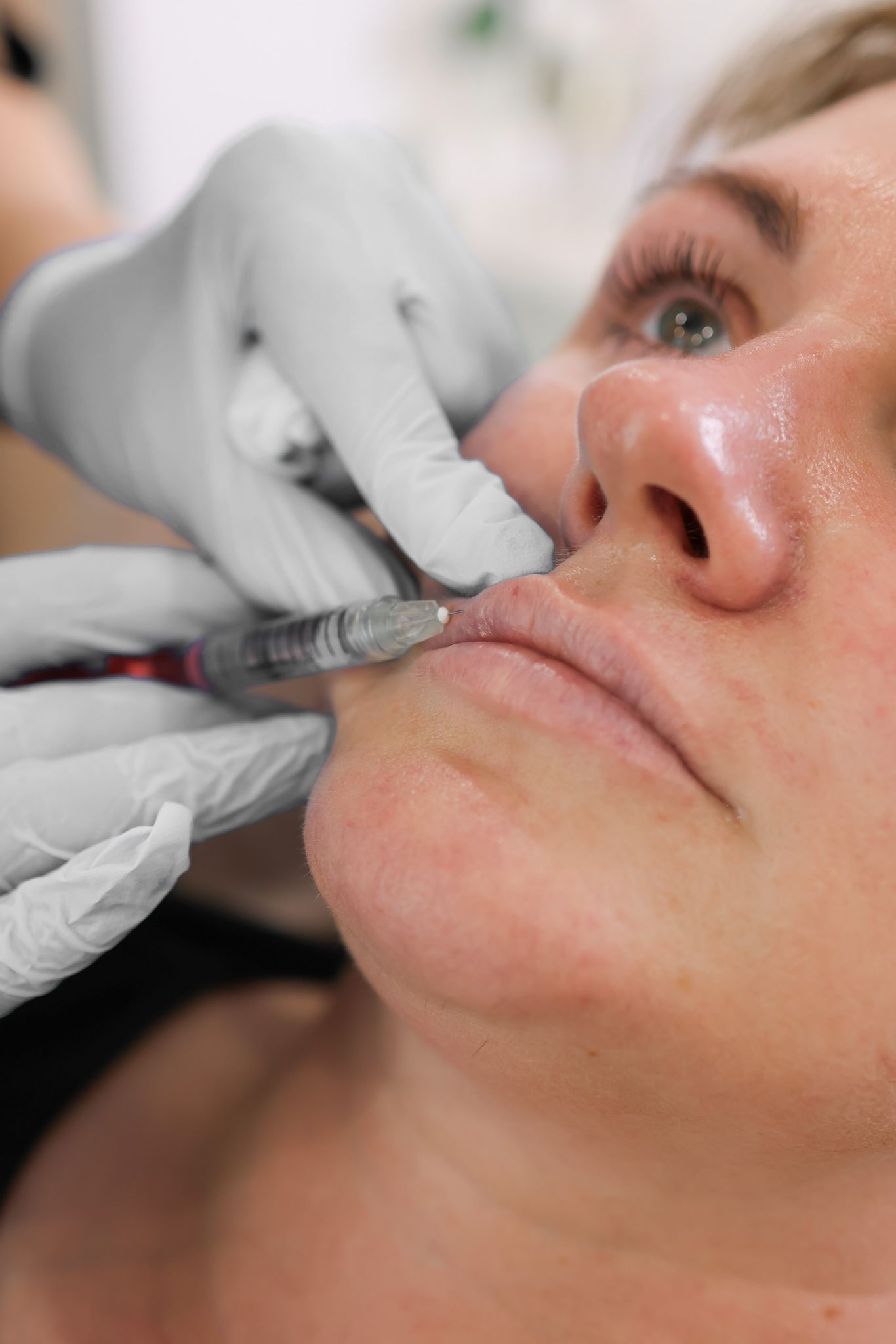 The Cost of Lip Fillers in the UK: What You Should Expect