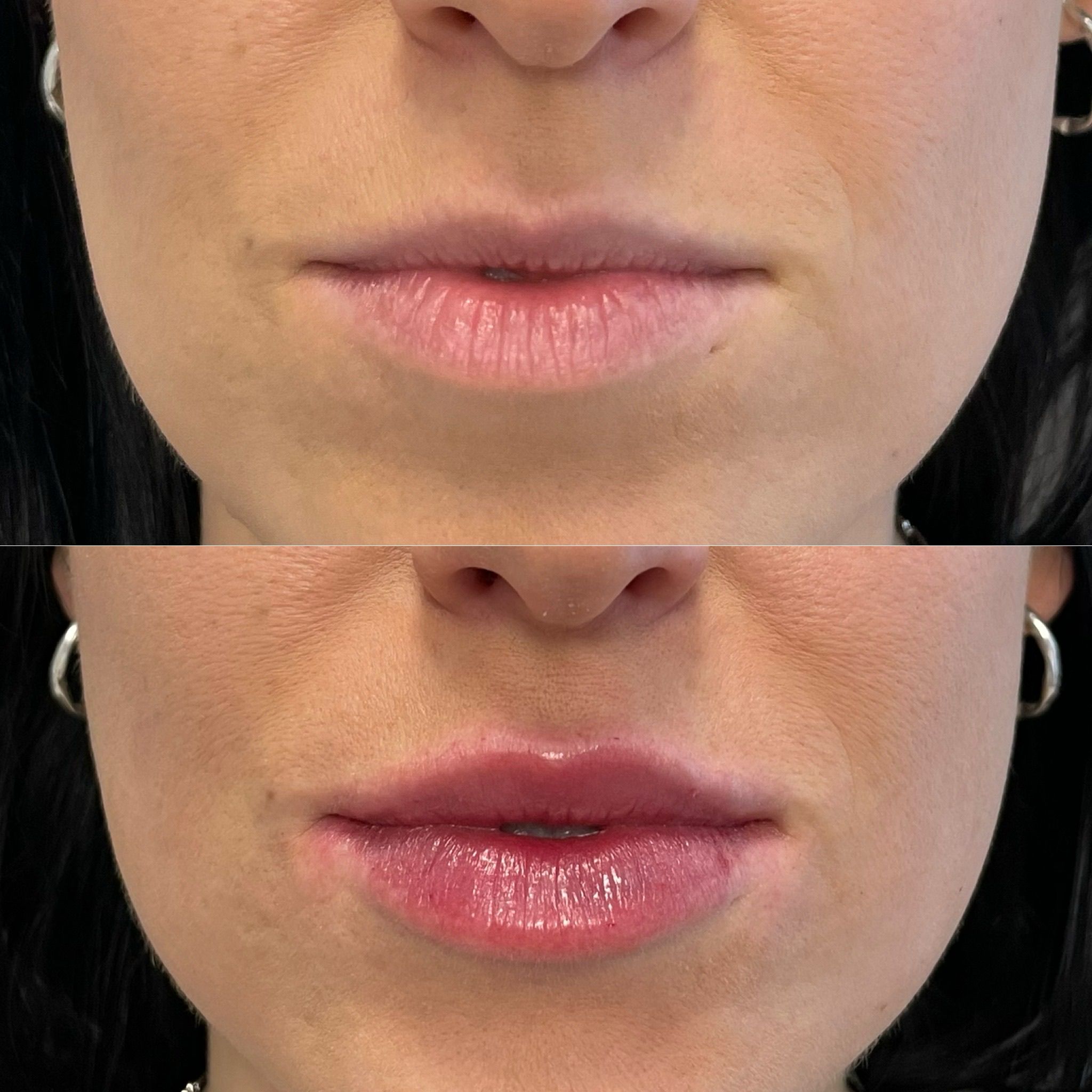 Lip Filler London – Lip Augmentation in London & Natural Lip Enhancement