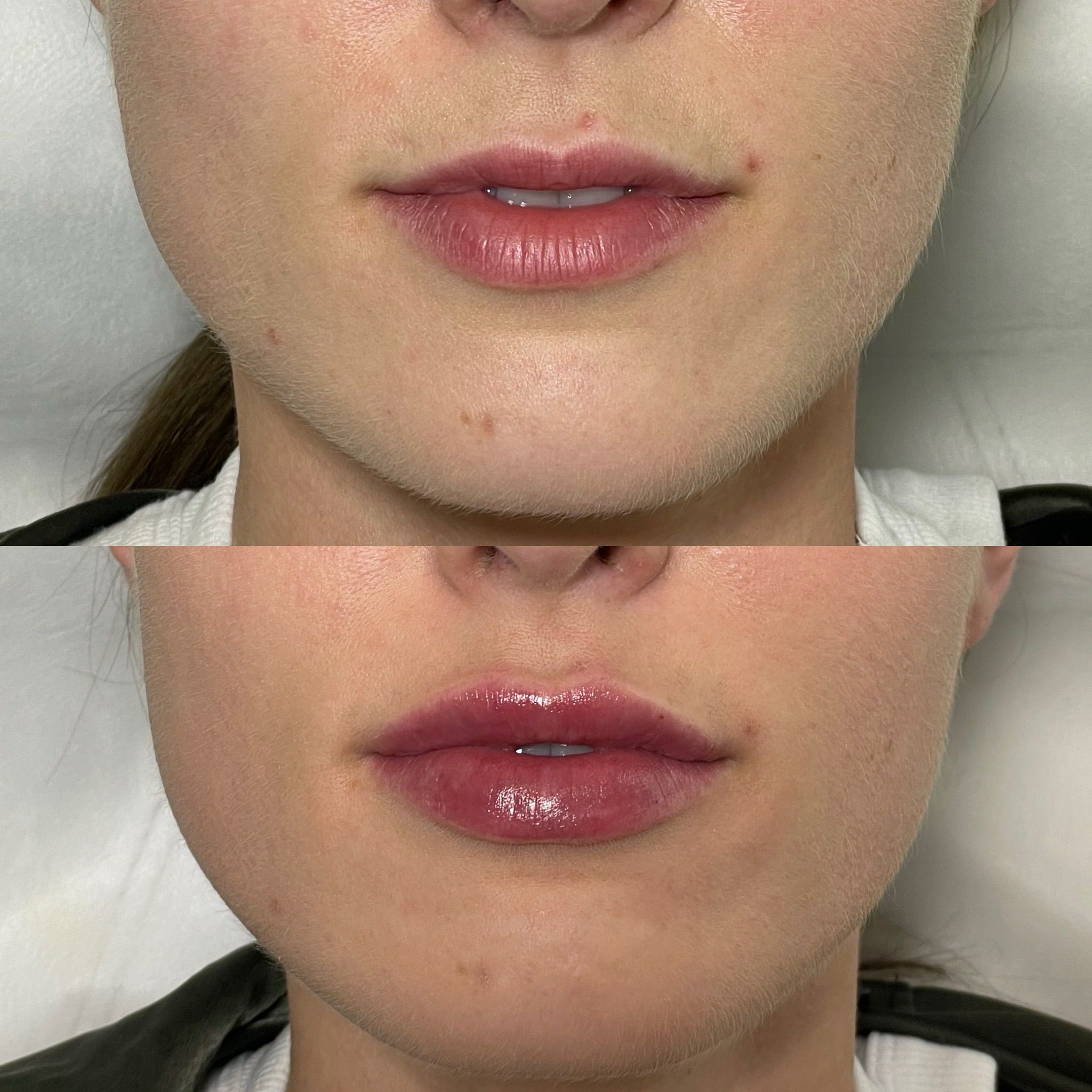 Lip Filler London – Lip Augmentation in London & Natural Lip Enhancement