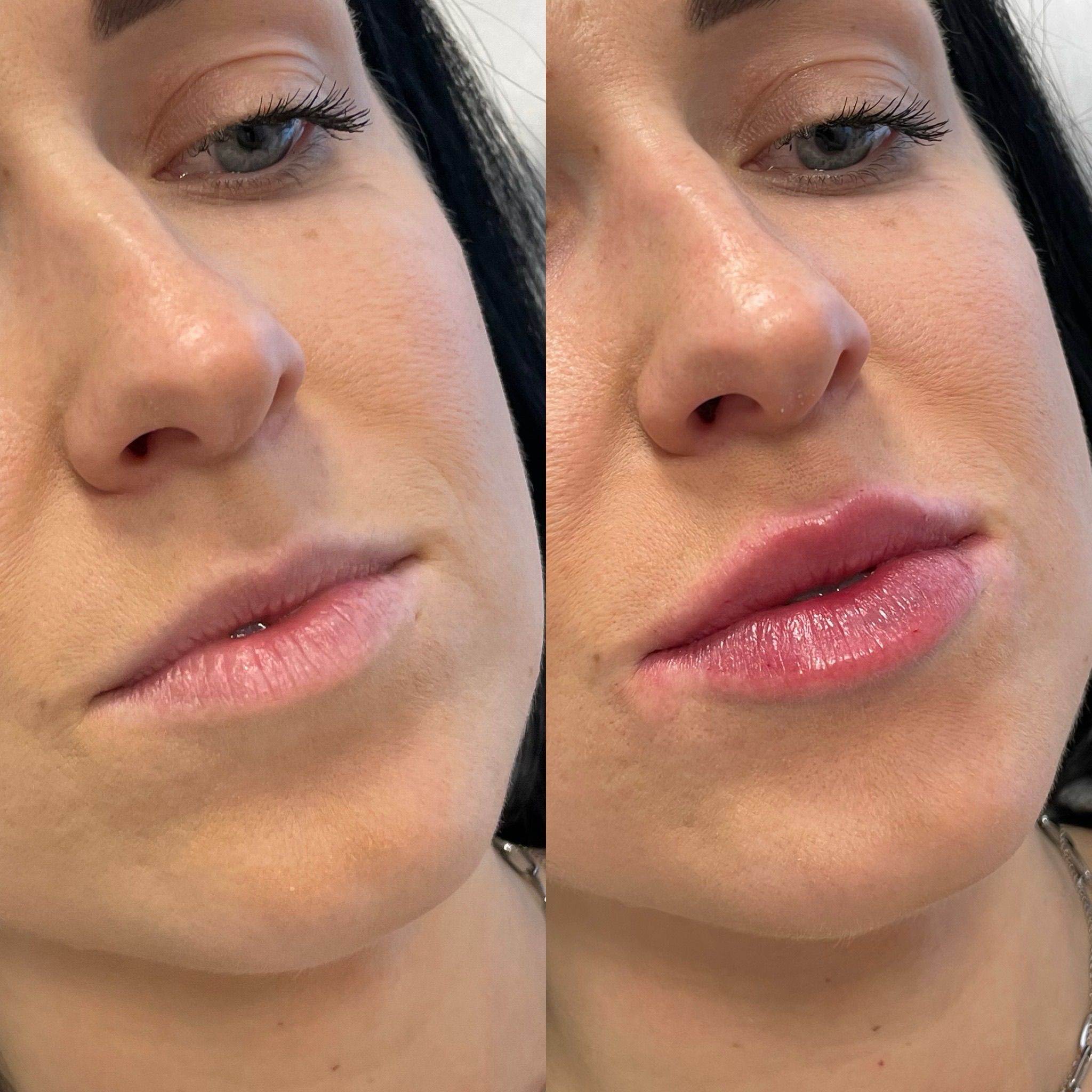 Lip Filler London – Lip Augmentation in London & Natural Lip Enhancement