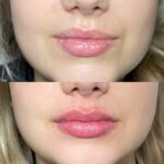Lip Filler London – Lip Augmentation in London & Natural Lip Enhancement