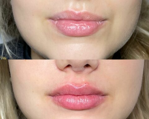 Lip Filler London – Lip Augmentation in London & Natural Lip Enhancement